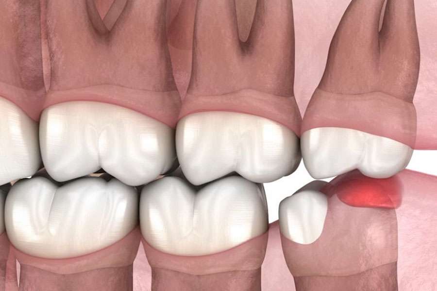 Zobna kirurgija Luxdental
